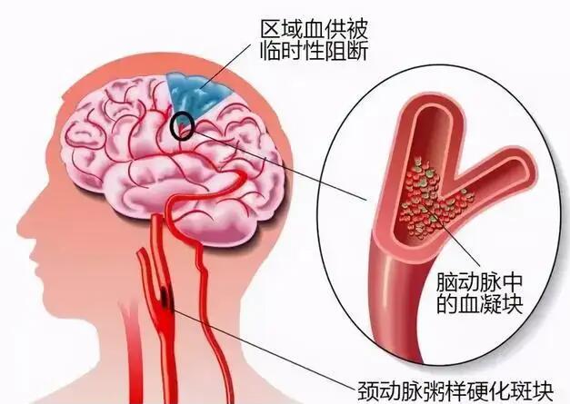 經顱多普勒儀器廠家?guī)私饽X動脈硬化的臨床表現(xiàn)